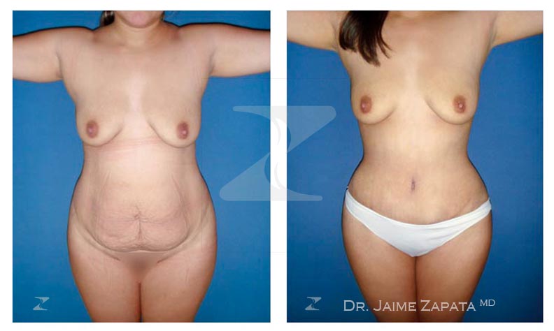 contorno natural de abdominoplastia realizada por jaime zapata cirujano plastico colombia