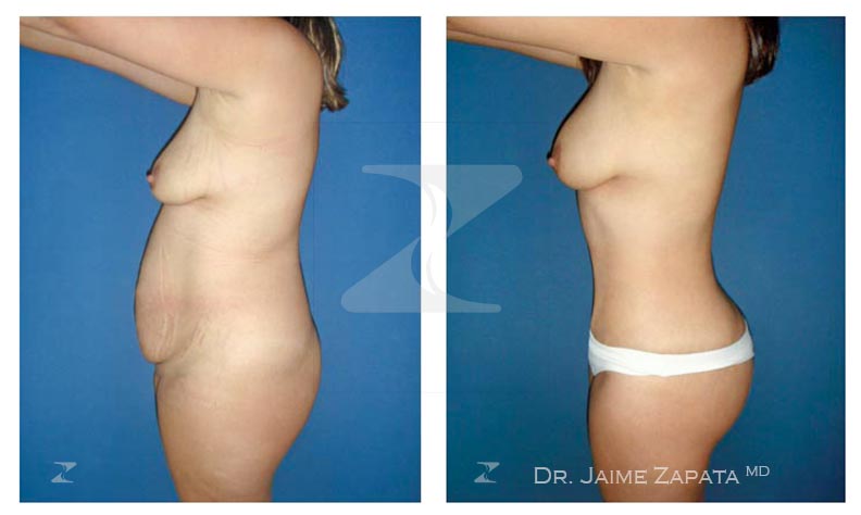 resultado natural de abdominoplastia realizada por jaime zapata cirujano plastico colombia