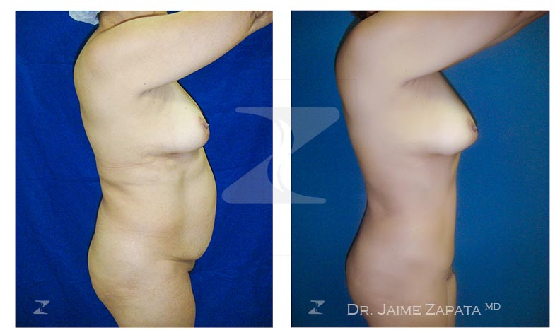 resultado natural abdominoplastia realizada por jaime zapata cirujano plastico colombia