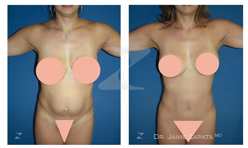 resultado abdominoplastia realizada por jaime zapata cirujano plastico colombia