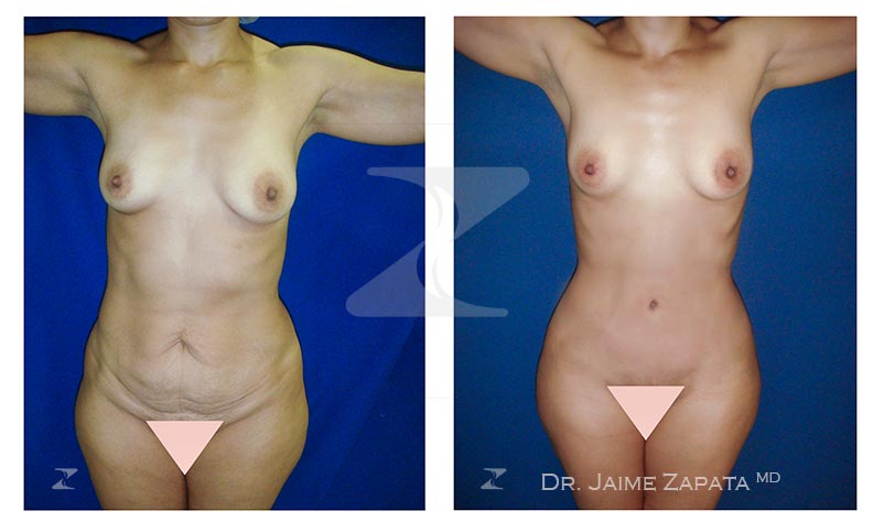 procedimiento abdominoplastia realizada por jaime zapata cirujano plastico colombia
