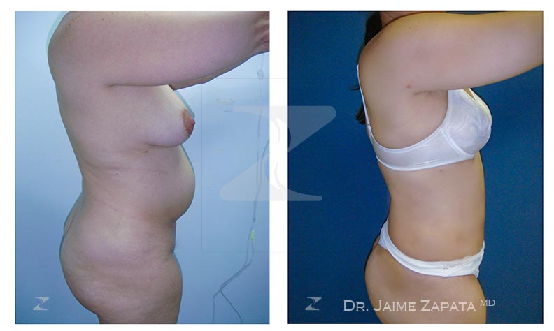 abdominoplastia realizada por jaime zapata cirujano plastico colombia