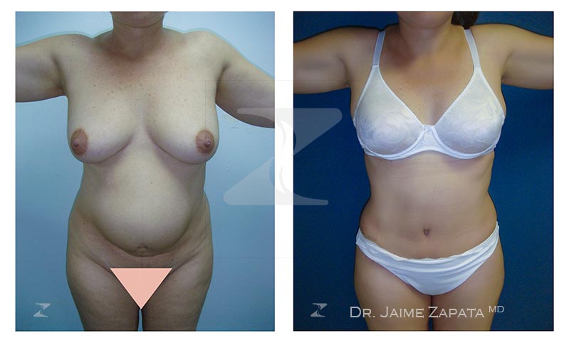 excelente abdominoplastia realizada por jaime zapata cirujano plastico colombia