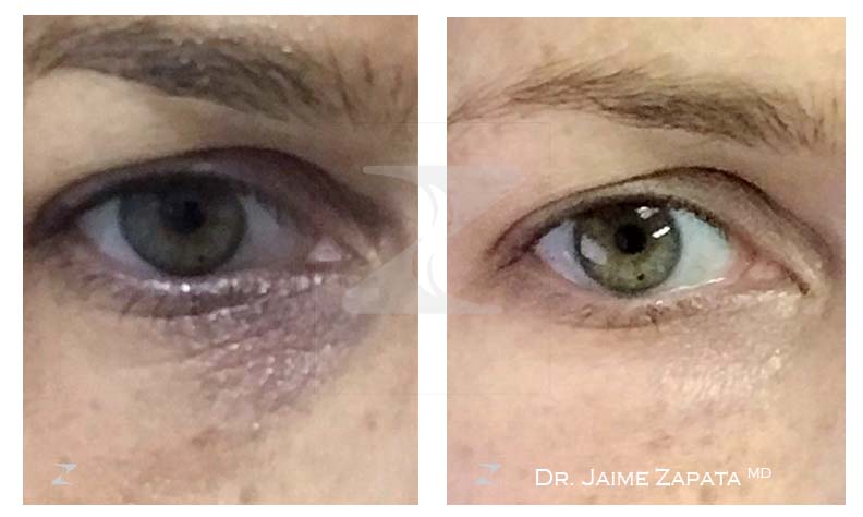 hyaluronic acid performed by doctor jaime zapata plastic surgeon colombia