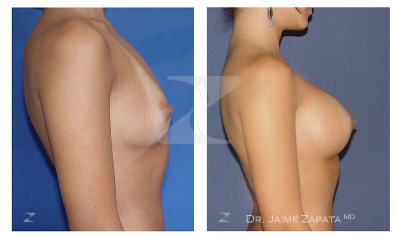 mammoplasty or breast augmentation with natural results performed by doctor Jaime Zapata plastic surgeon Colombia