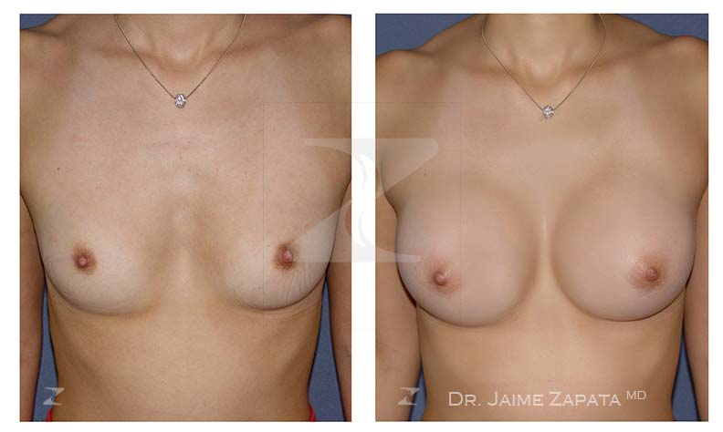 Aumento de senos (mamoplastia) con resultados naturales realizada por el doctor Jaime Zapata cirujano plástico Colombia