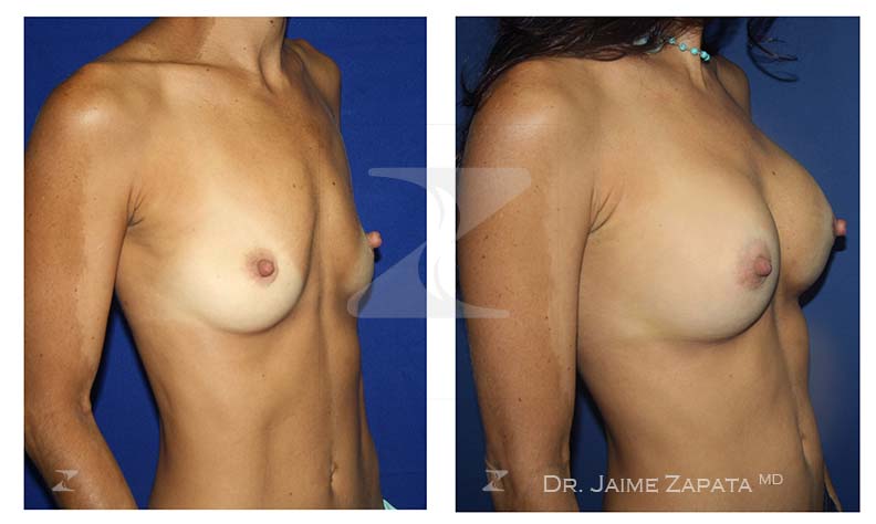 Aumento de senos (mamoplastia) realizada por el doctor Jaime Zapata cirujano plástico Colombia