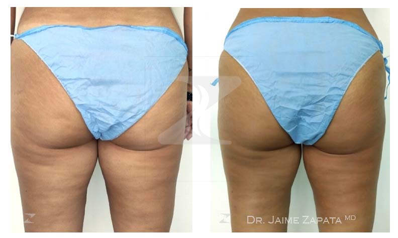 cellulite deusas medical spa