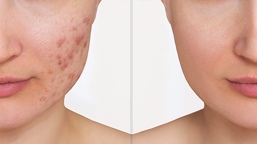 acne