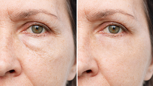 blefaroplastia cirugia de parpados