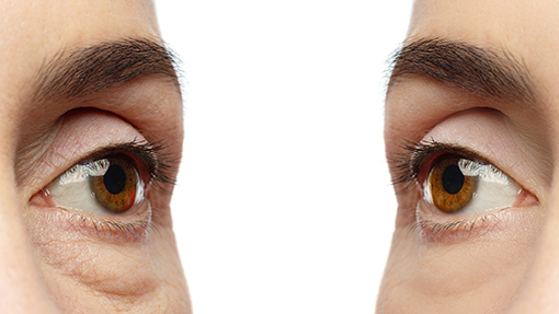 cirugia de parpados blefaroplastia 