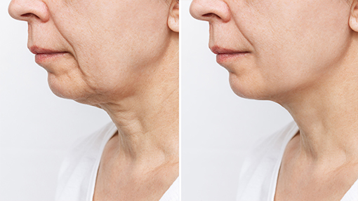 lifting facial