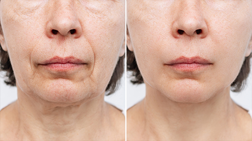 lipoestructura facial
