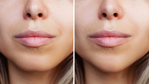 procedimiento de lipoestructura facial