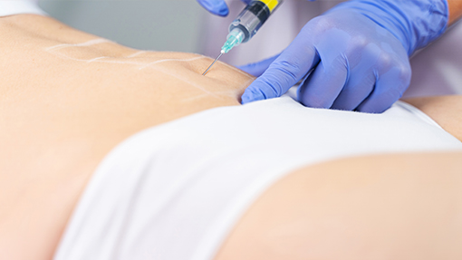 mesotherapy dr jaime zapata plastic surgeon colombia