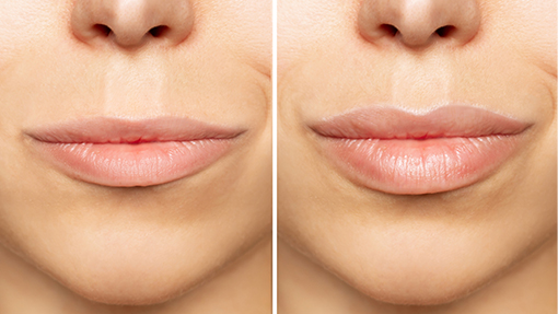 queiloplastia cirujia de labios