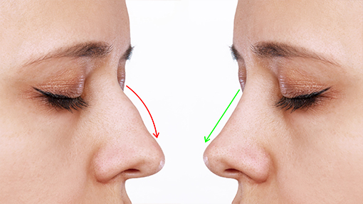 rinoplastia cirugia de nariz