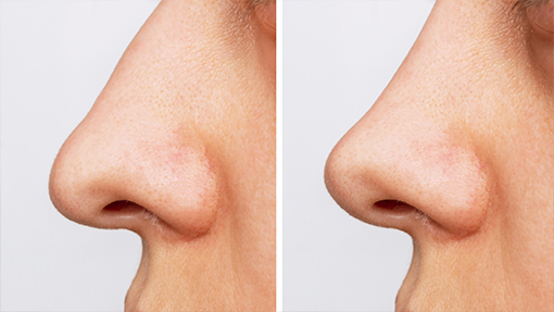 rinoplastia nariz