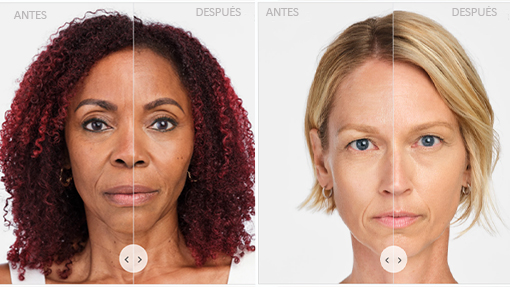 radiesse in deusas medical spa