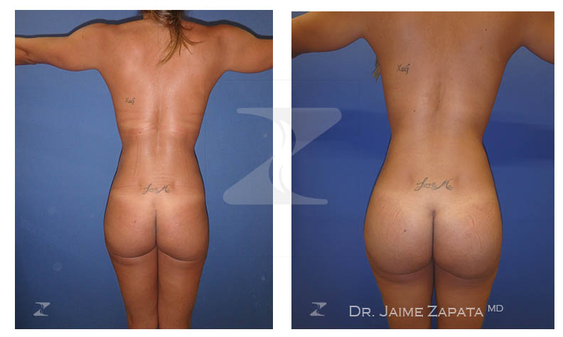 el reconocido doctor jaime zapata cirujano plastico colombia procedimiento de gluteoplastia