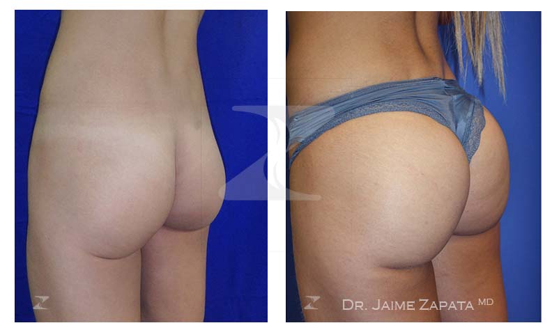 jaime zapata plastic surgeon colombia gluteoplasty procedure