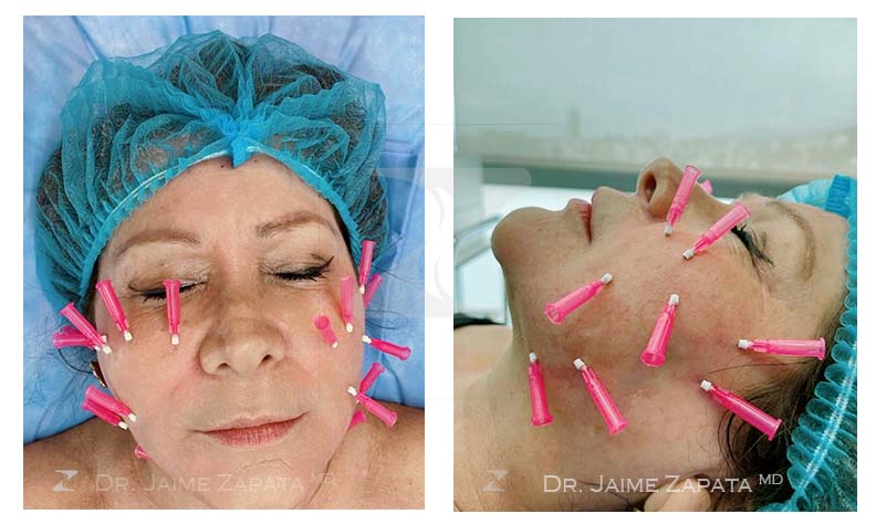 thread lifts pdo doctor jaime zpata plastic surgeon
