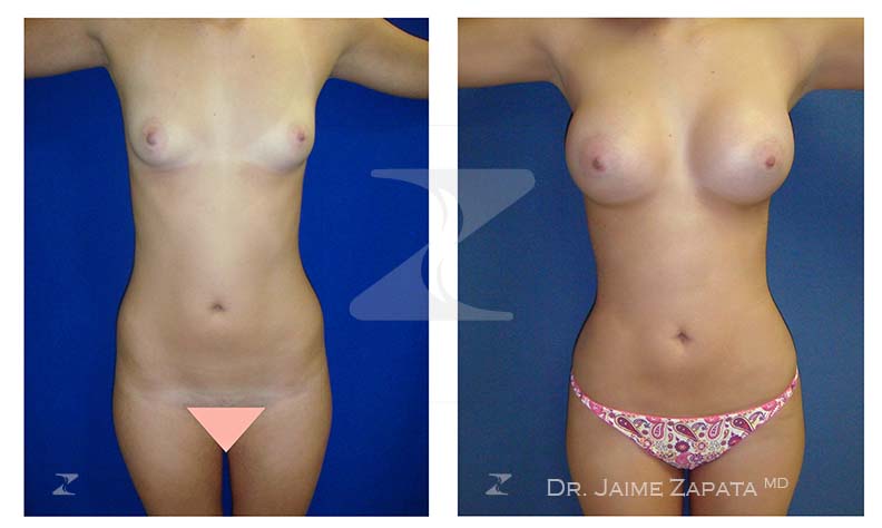 hermoso resultado doble procedimiento de lipoescultura y aumento de senos con resultados realizado por jaime zapata cirujano plastico