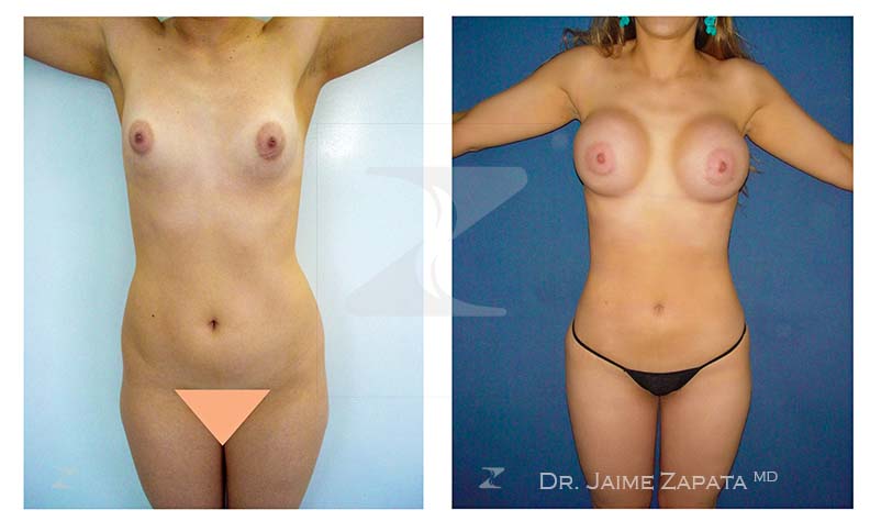 lipoescultura y aumento de senos mamoplastia dr jaime zapata cirujano plastico