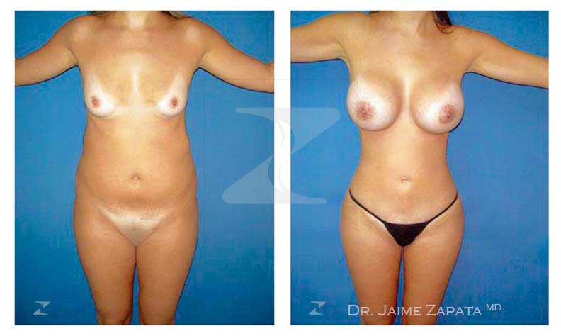 lipoescultura y aumento de senos mamoplastia dr jaime zapata cirujano plastico