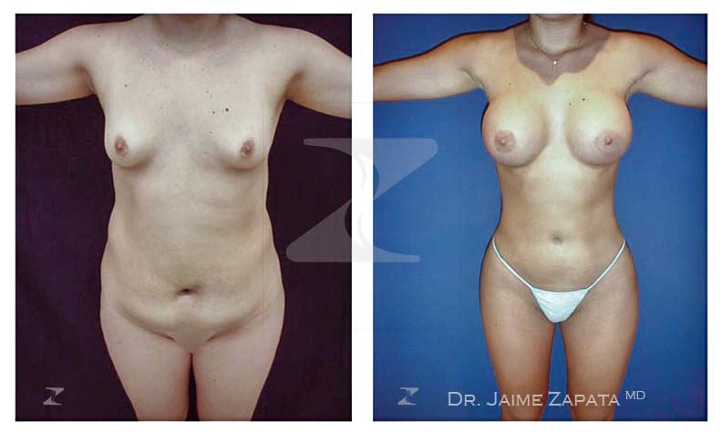 lipoescultura y aumento de senos mamoplastia dr jaime zapata cirujano plastico