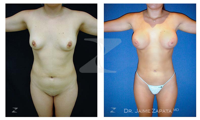 fabuloso doble procedimiento de lipoescultura y aumento de senos con resultados realizado por jaime zapata cirujano plastico