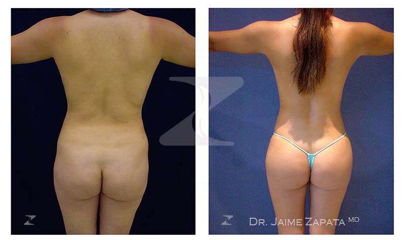doble procedimiento de lipoescultura y aumento de senos con resultados realizado por jaime zapata cirujano plastico
