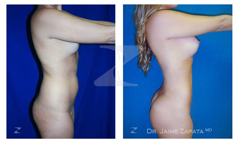 doble procedimiento de lipoescultura y aumento de senos realizado por jaime zapata cirujano plastico