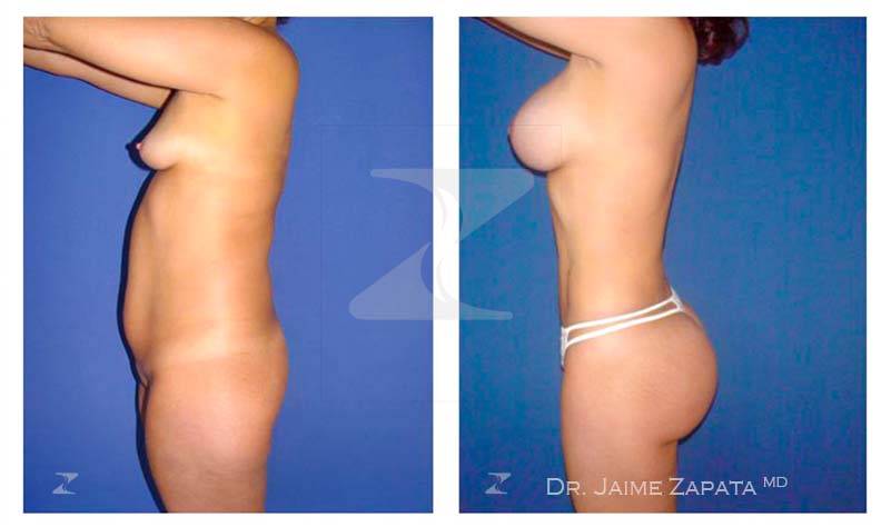 lipoescultura y aumento de senos mamoplastia dr jaime zapata cirujano plastico