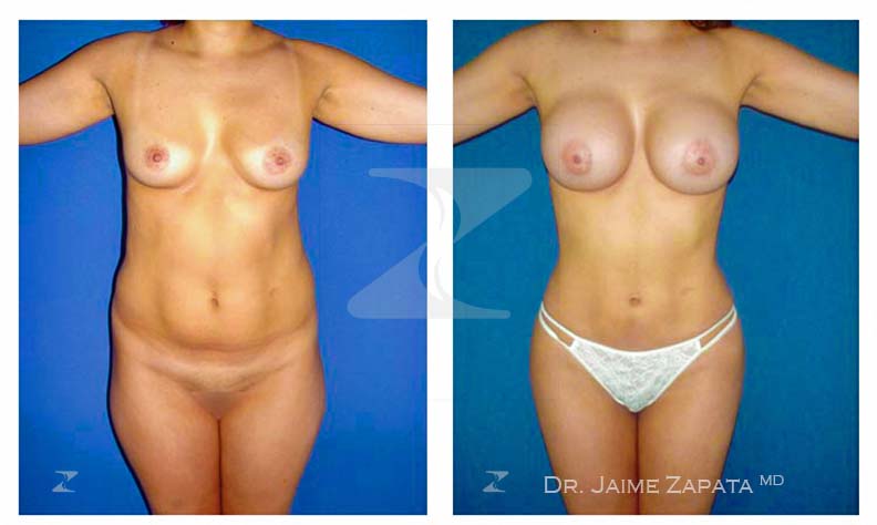 lipoescultura y aumento de senos mamoplastia dr jaime zapata cirujano plastico