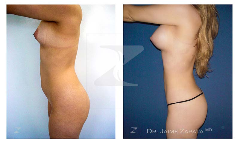 lipoescultura y aumento de senos mamoplastia dr jaime zapata cirujano plastico