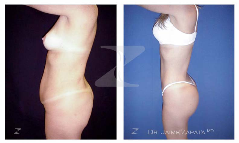 silueta natual con la lipoescultura realizada por jaime zapata cirujano pastico