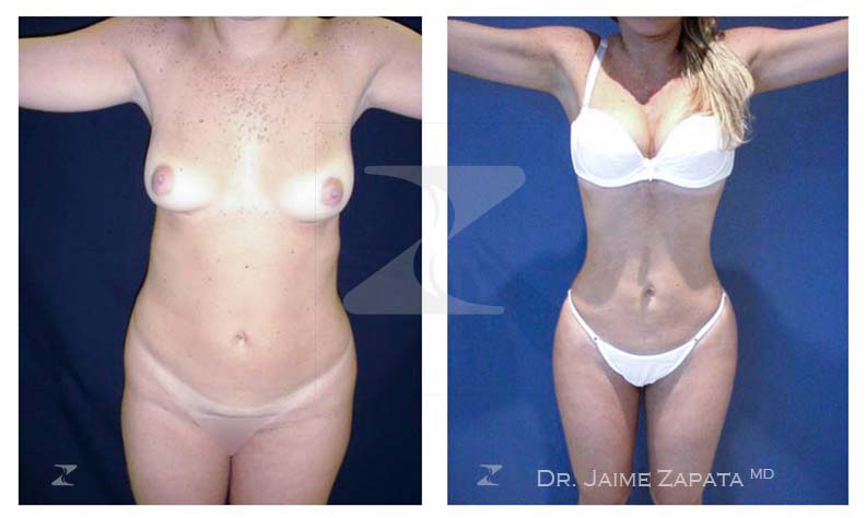excelente resultado de la  lipoescultura realizada por jaime zapata cirujano pastico