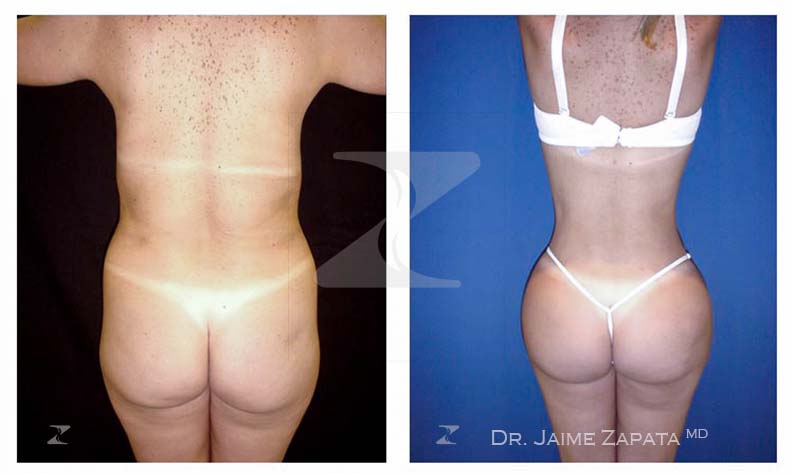 gran resultado de la  lipoescultura realizada por jaime zapata cirujano pastico