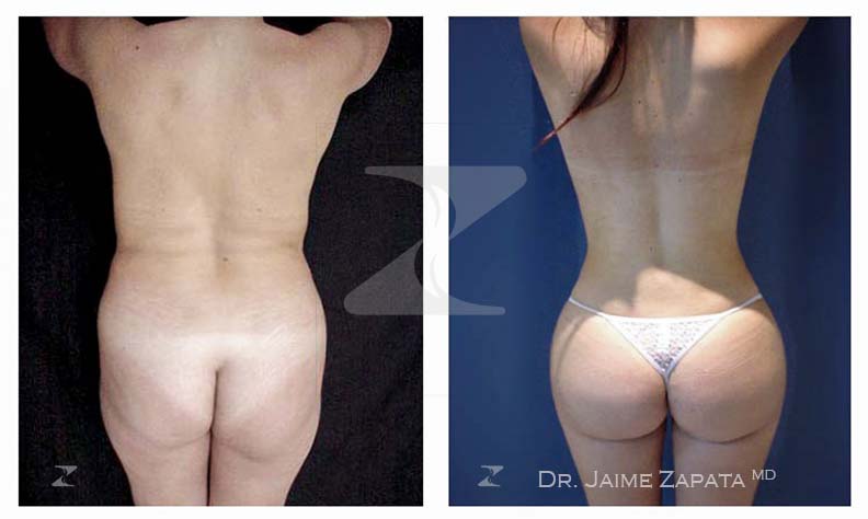 resultado natural y gran figura con la  lipoescultura realizada por jaime zapata cirujano pastico