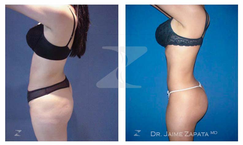 resultado natural con la  lipoescultura realizada por jaime zapata cirujano pastico
