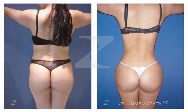 fabulosa lipoescultura realizada por jaime zapata cirujano pastico