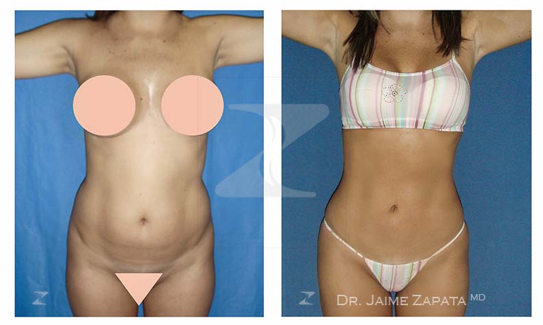 increible resultado con lipoescultura realizada por jaime zapata cirujano pastico