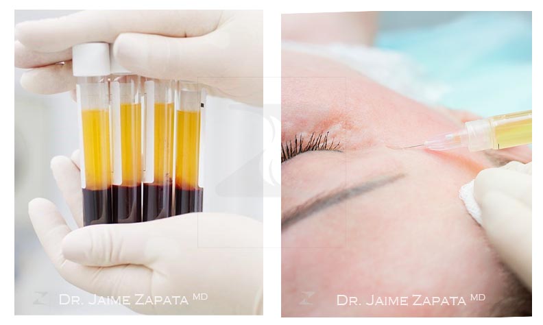 platelet rich plasma performed by doctor jaime zapata plastic surgeon colombia