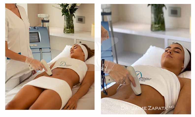 deusas medical spa radiofrequency