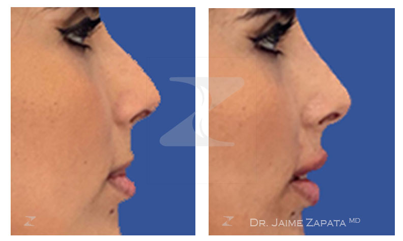 rhinomodeling performed by doctor jaime zapata plastic surgeon colombia