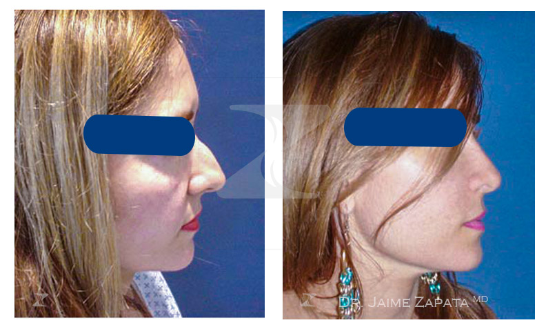 nose plastic surgery (rhinoplasty) performed by doctor jaime zapata plastic surgeon cali colombia